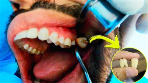 extrair dente siso é perigoso